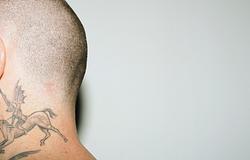 Tetoválás és melanoma: van összefüggés?