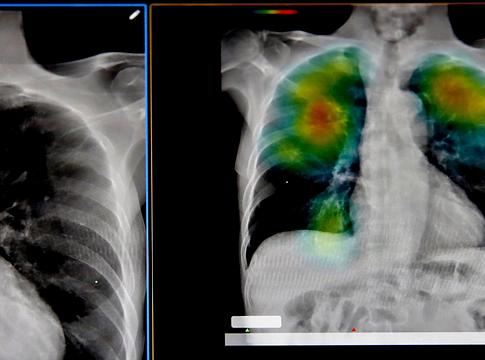AI-alapú korAI diagnózis: beteg leszel, mielőtt betegnek érzed magad?