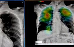 AI-alapú korAI diagnózis: beteg leszel, mielőtt betegnek érzed magad?